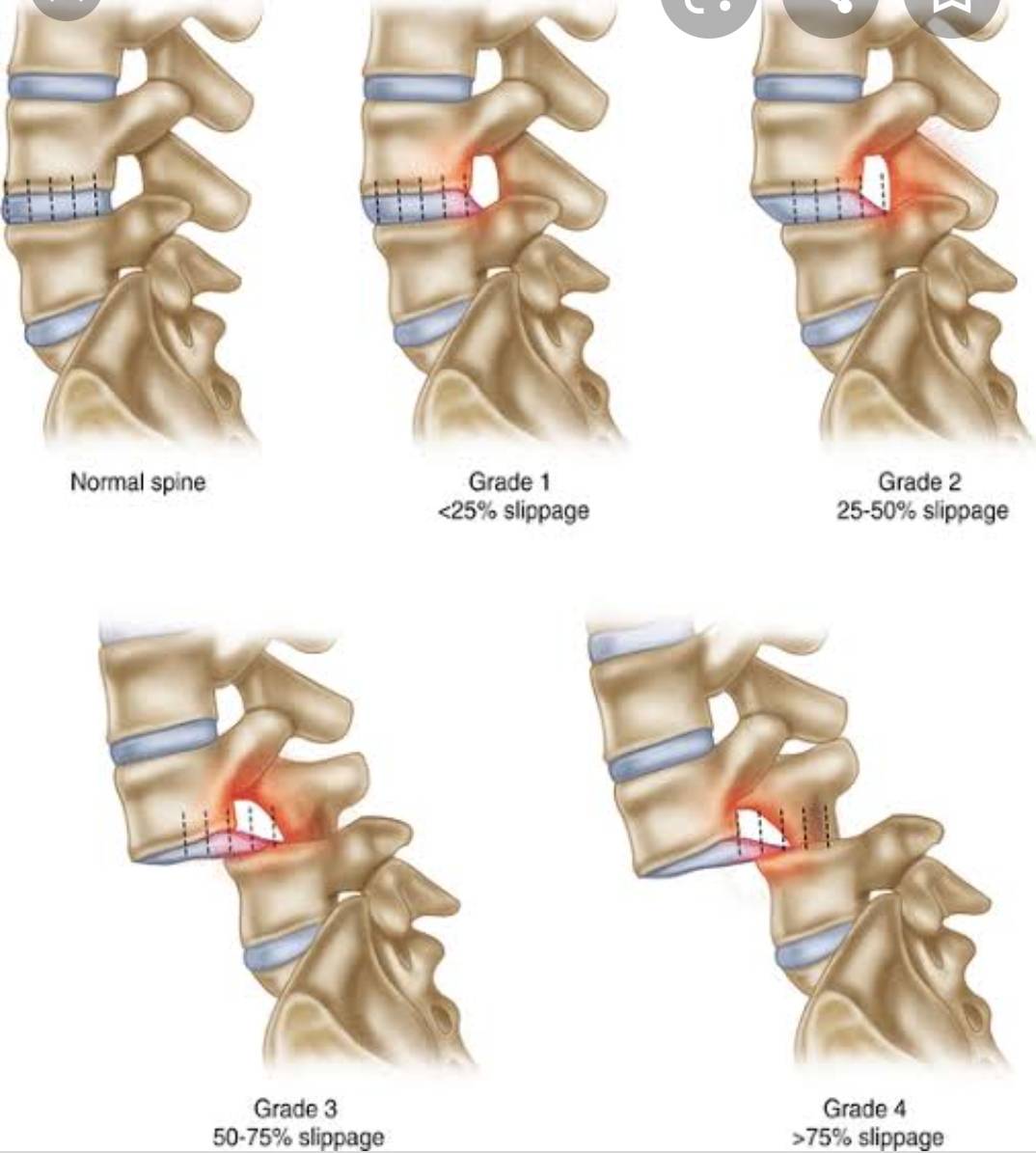 lumbar-instability